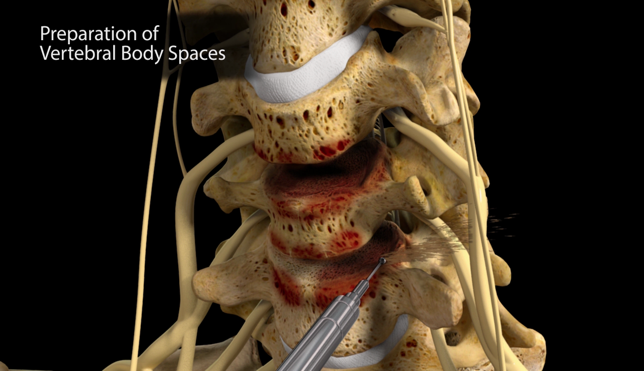 Example-of-Spinal-Surgery